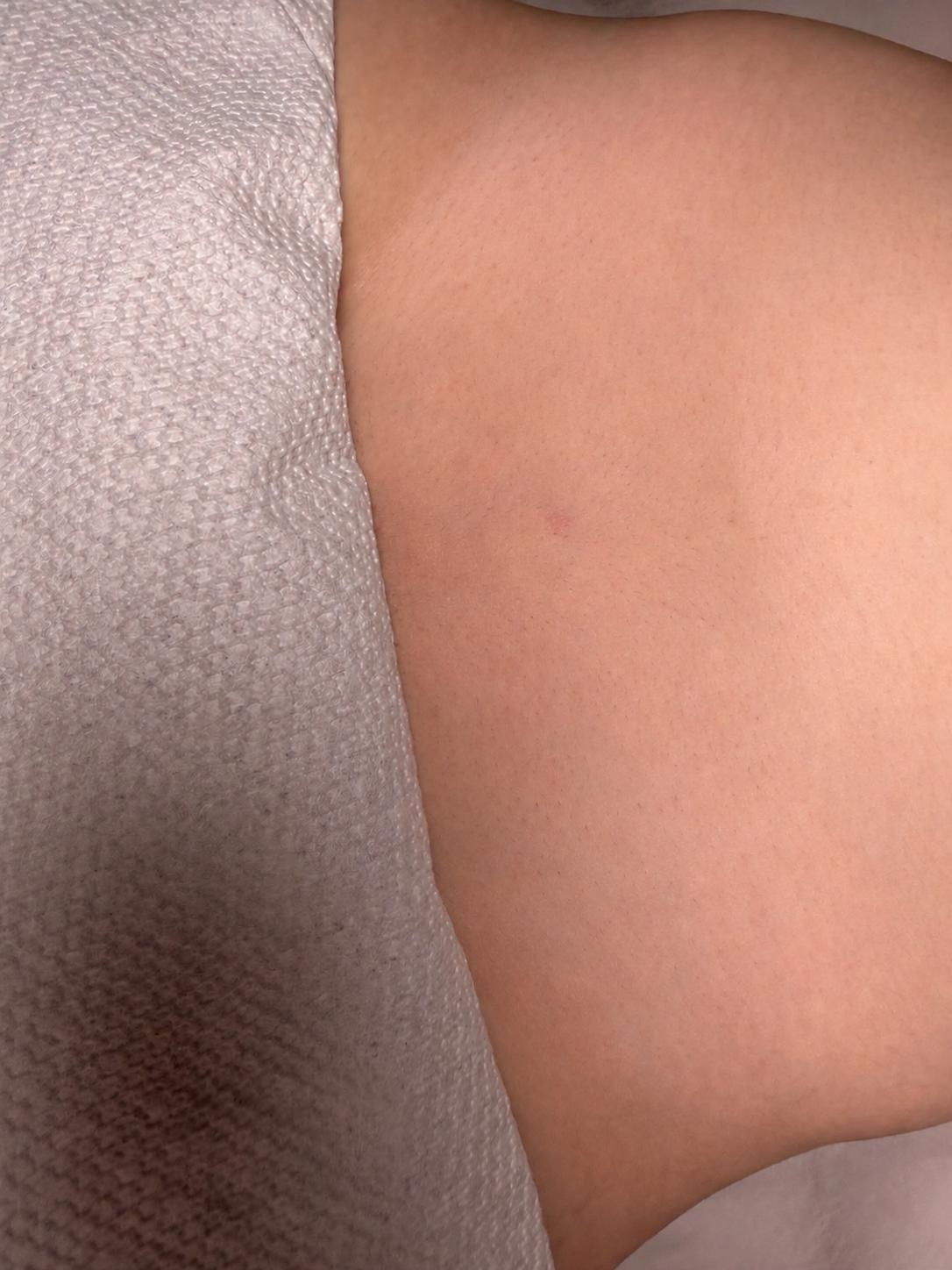 Smoother belly area after treatment