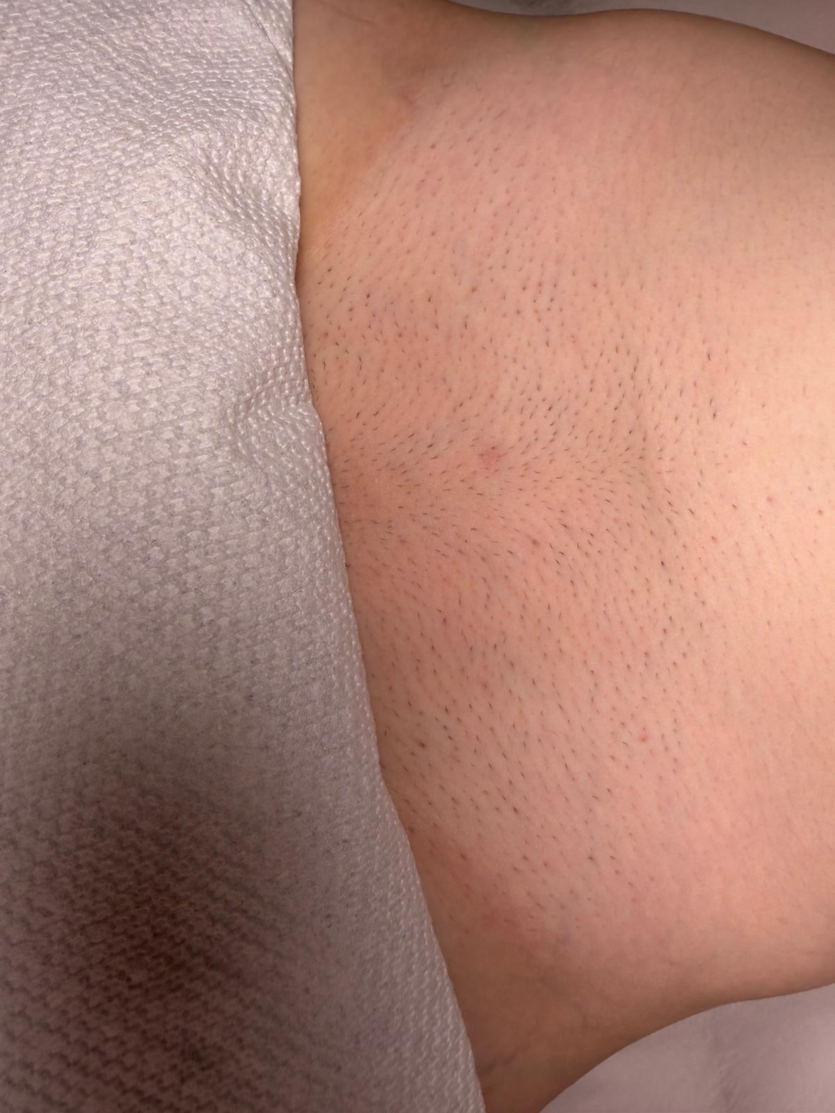 Hair growth before treatment on belly area