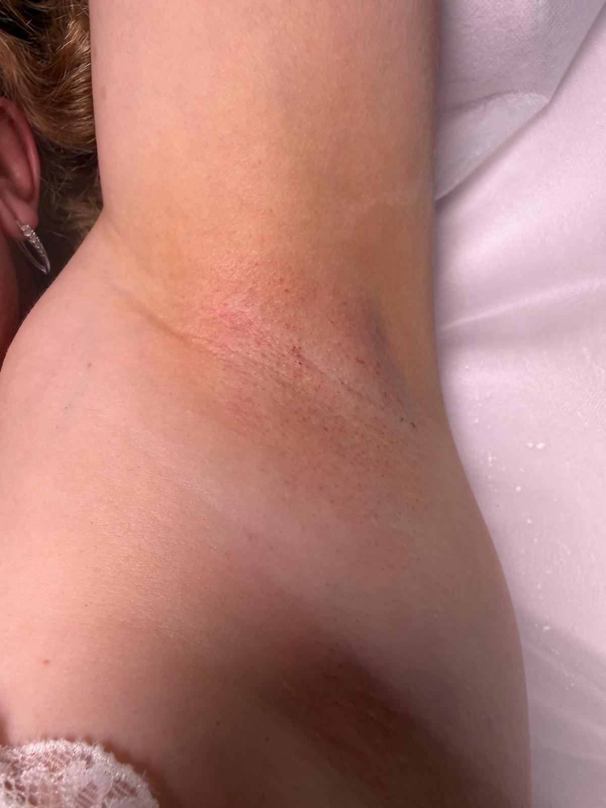 Underarm area after treatment