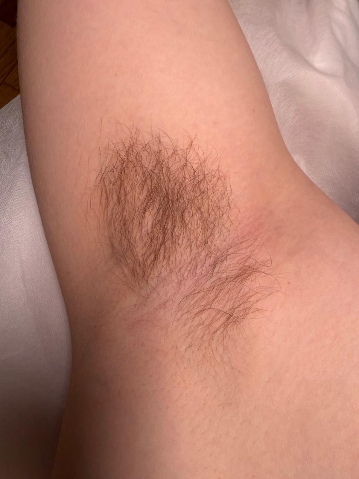 Underarm hair before treatment