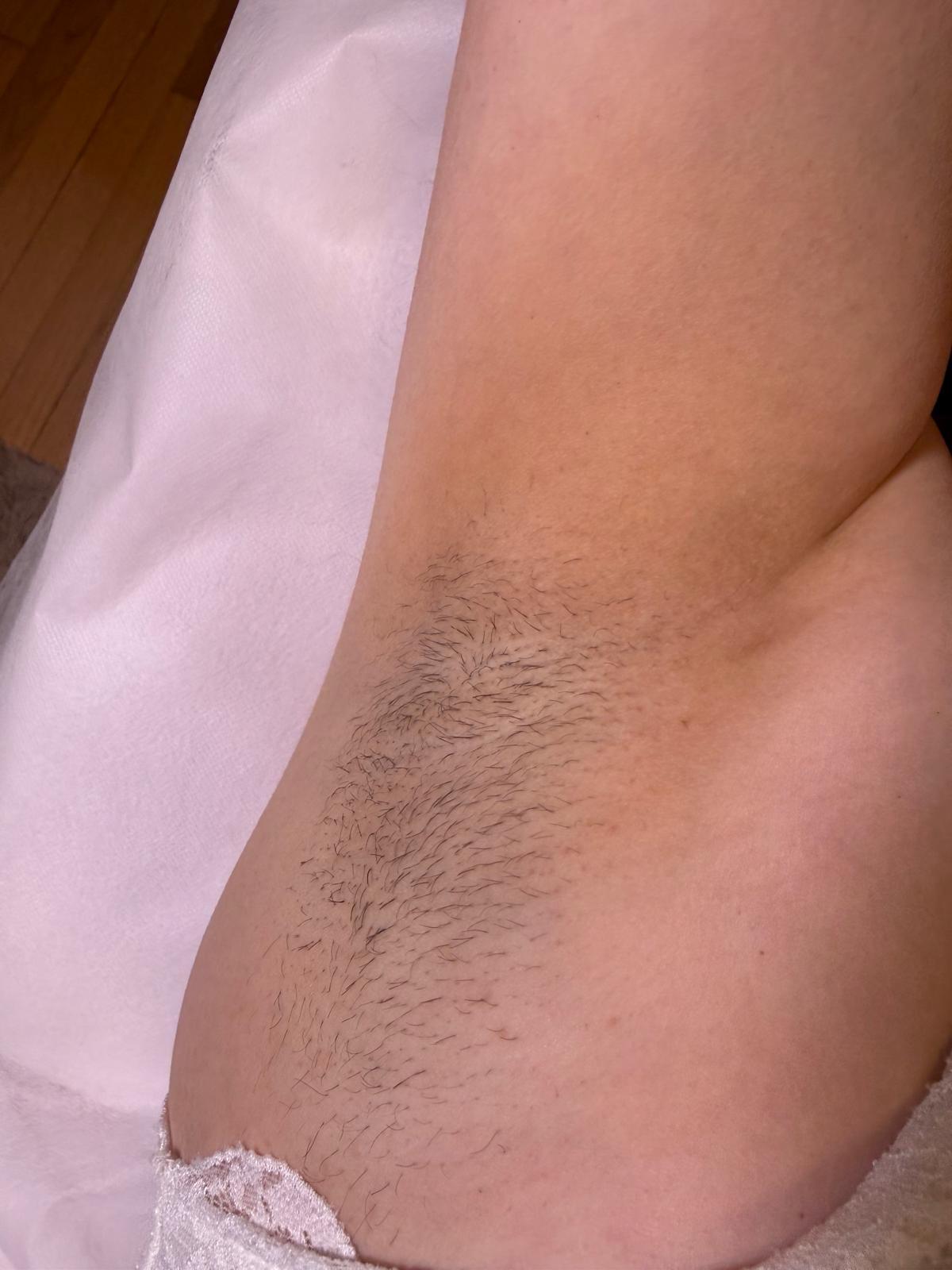 Underarm hair before a treatment appointment
