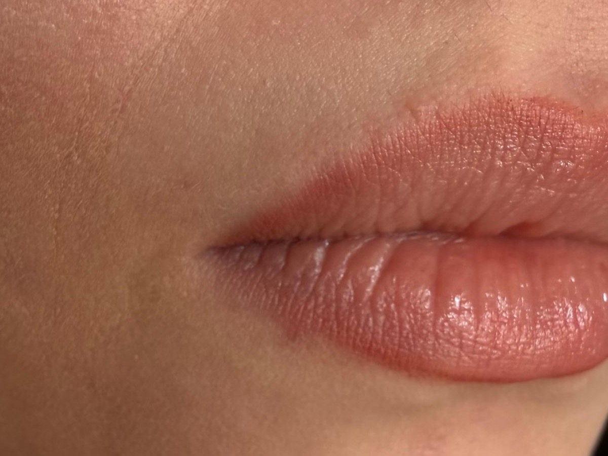 Upper lip area after treatment