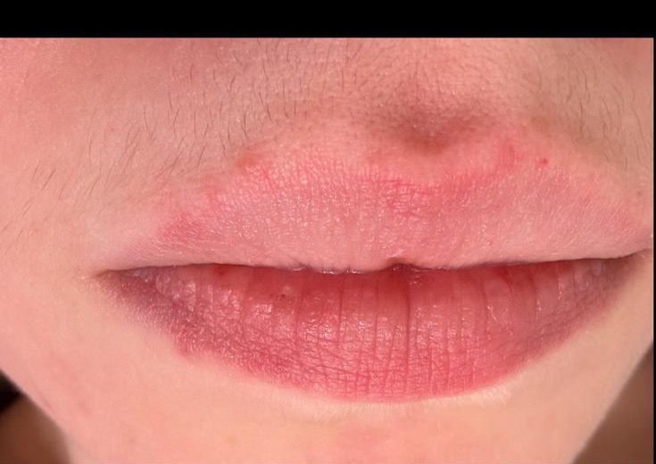 Upper lip hair before treatment
